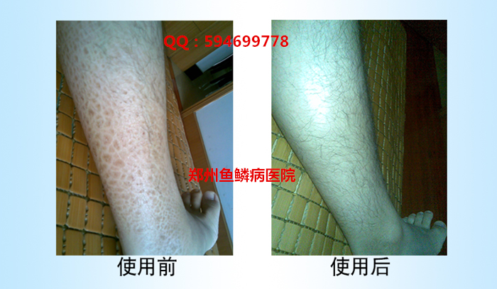 寻常型鱼鳞病怎么治疗