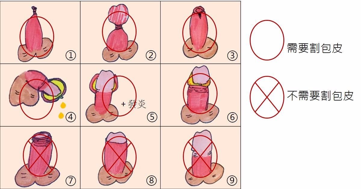 包皮包茎是男人难言的痛