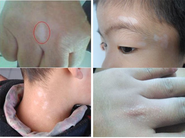 白癜风初期病情较轻,白斑面积较小,如果此时治疗,周围正常皮肤的黑素