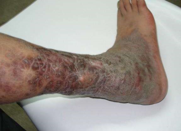 下肢老烂腿的常见治疗误区有哪此